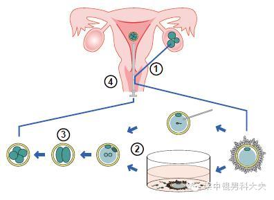 简介人工授精与试管婴儿