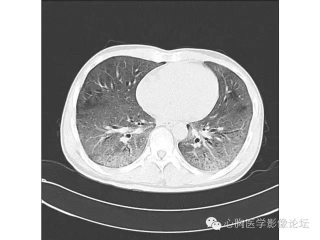 建议查hiv clarify 19:55@西京医院放射科 袁怀平[握手[握手[握手]