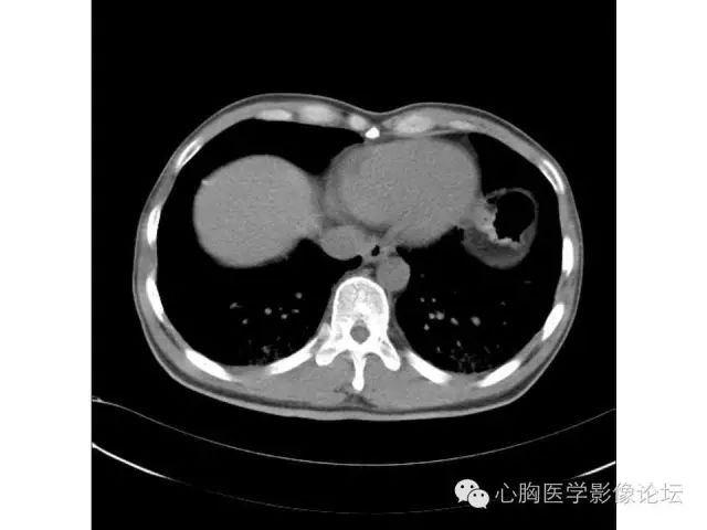 建议查hiv clarify 19:55@西京医院放射科 袁怀平[握手[握手[握手]