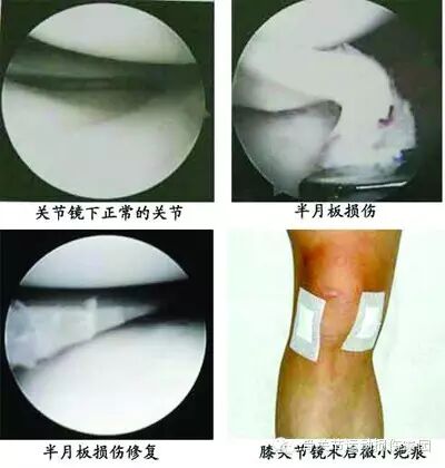 如何判断膝关节半月板损伤