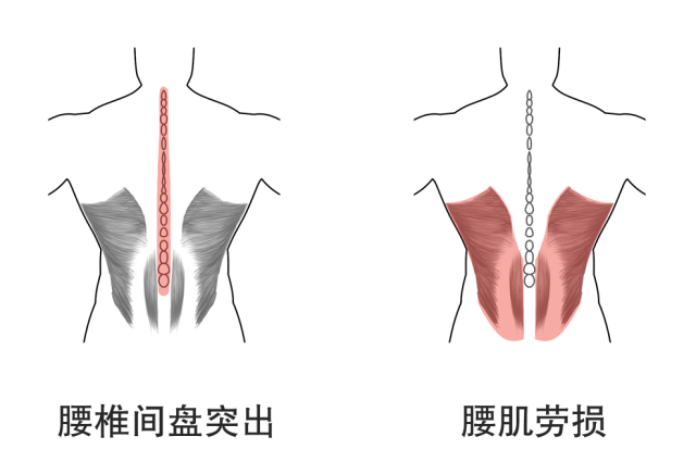 腰椎間盤突出的運動康復攻略 健康 第2張