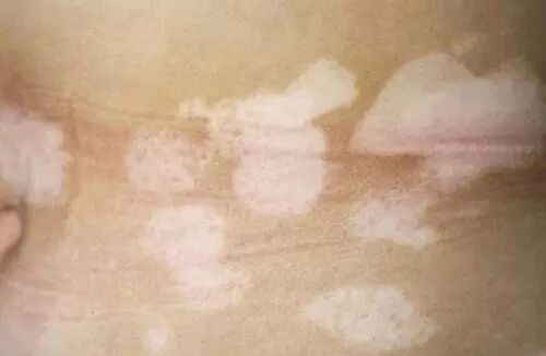 白癜风易复发？收好这份白癜风抗复发攻略，让你的白斑早日治愈！