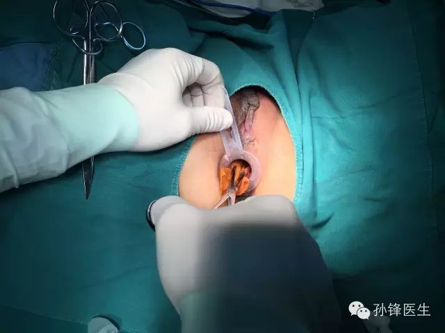 pph吻合器怎么使用手把手教你：痔的经典手术——PPH_https://www.jmylbn.com_新闻资讯_第6张