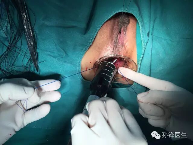 pph吻合器怎么使用手把手教你：痔的经典手术——PPH_https://www.jmylbn.com_新闻资讯_第15张