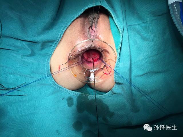 pph吻合器怎么使用手把手教你：痔的经典手术——PPH_https://www.jmylbn.com_新闻资讯_第11张