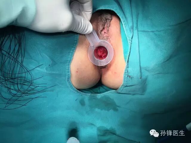pph吻合器怎么使用手把手教你：痔的经典手术——PPH_https://www.jmylbn.com_新闻资讯_第21张