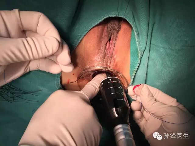 pph吻合器怎么使用手把手教你：痔的经典手术——PPH_https://www.jmylbn.com_新闻资讯_第13张