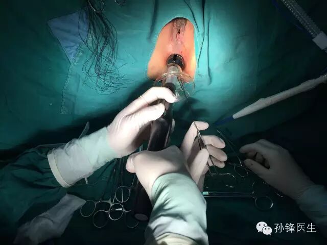 pph吻合器怎么使用手把手教你：痔的经典手术——PPH_https://www.jmylbn.com_新闻资讯_第20张