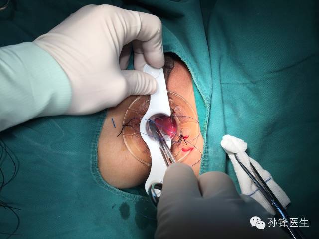 pph吻合器怎么使用手把手教你：痔的经典手术——PPH_https://www.jmylbn.com_新闻资讯_第10张