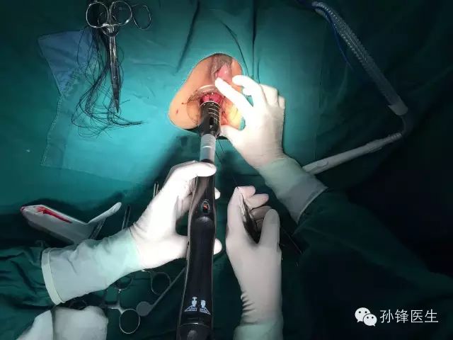 pph吻合器怎么使用手把手教你：痔的经典手术——PPH_https://www.jmylbn.com_新闻资讯_第17张