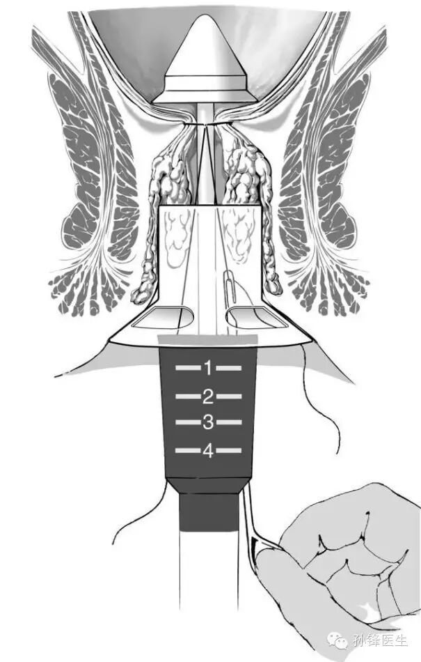 pph吻合器怎么使用手把手教你：痔的经典手术——PPH_https://www.jmylbn.com_新闻资讯_第14张