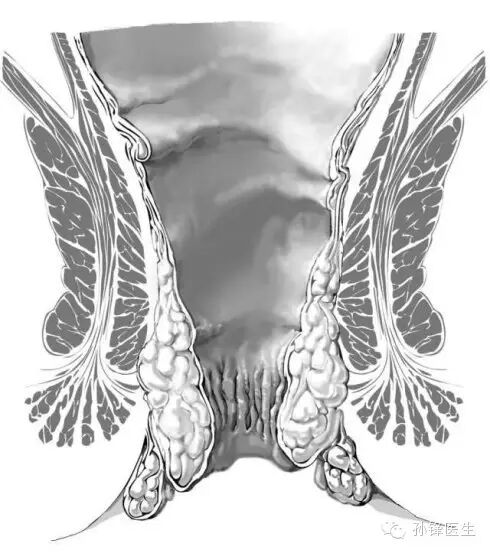 pph吻合器怎么使用手把手教你：痔的经典手术——PPH_https://www.jmylbn.com_新闻资讯_第5张