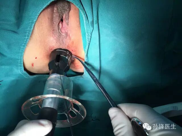 pph吻合器怎么使用手把手教你：痔的经典手术——PPH_https://www.jmylbn.com_新闻资讯_第19张
