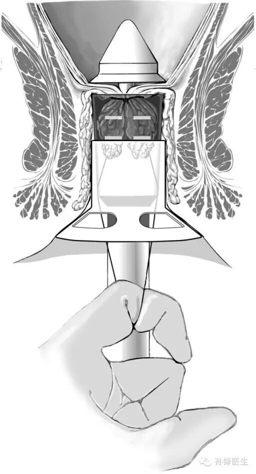 pph吻合器怎么使用手把手教你：痔的经典手术——PPH_https://www.jmylbn.com_新闻资讯_第16张