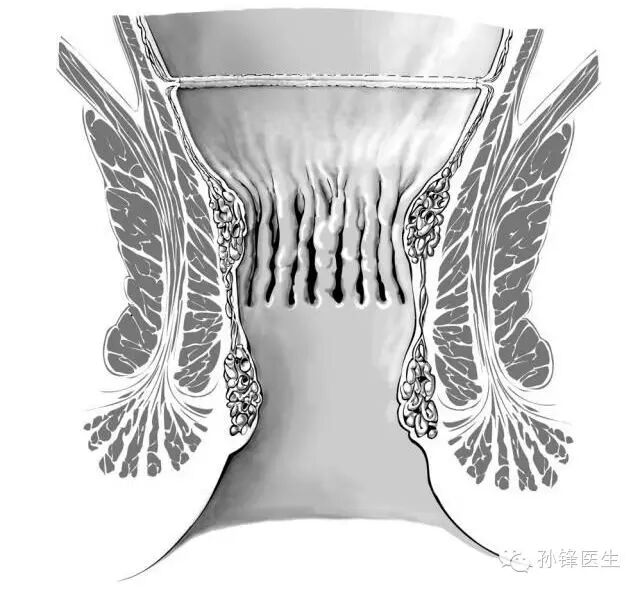 pph吻合器怎么使用手把手教你：痔的经典手术——PPH_https://www.jmylbn.com_新闻资讯_第22张