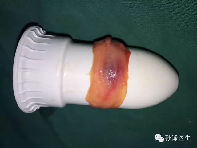 pph吻合器怎么使用手把手教你：痔的经典手术——PPH_https://www.jmylbn.com_新闻资讯_第23张