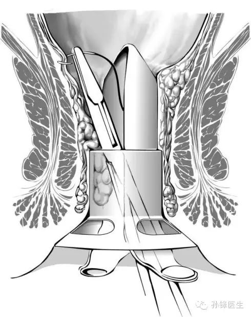 pph吻合器怎么使用手把手教你：痔的经典手术——PPH_https://www.jmylbn.com_新闻资讯_第9张