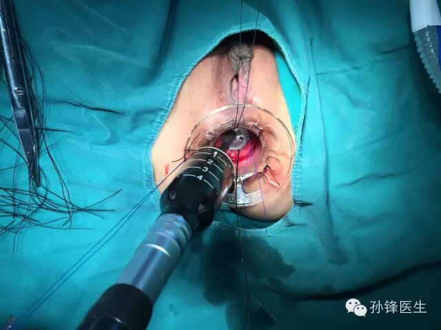 pph吻合器怎么使用手把手教你：痔的经典手术——PPH_https://www.jmylbn.com_新闻资讯_第12张