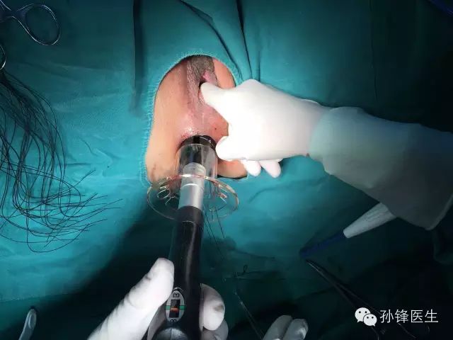 pph吻合器怎么使用手把手教你：痔的经典手术——PPH_https://www.jmylbn.com_新闻资讯_第18张