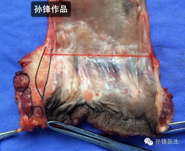 图(5):肛管—直肠线(标本图,红线)图(6):肛管粘膜下层静脉丛扒开肛管