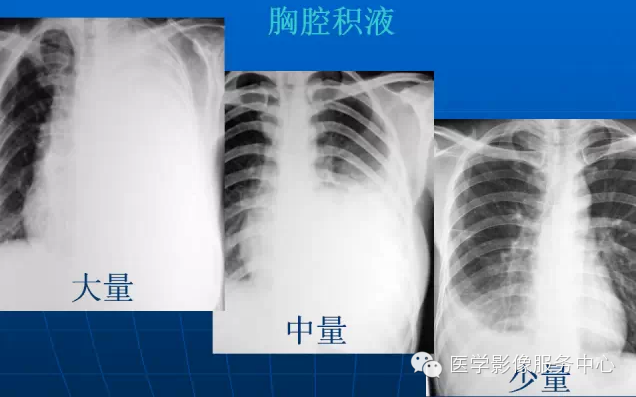 大量积液:(第2前肋水平以上)纵膈向健侧移位,横膈下移,肋间隙变宽,中