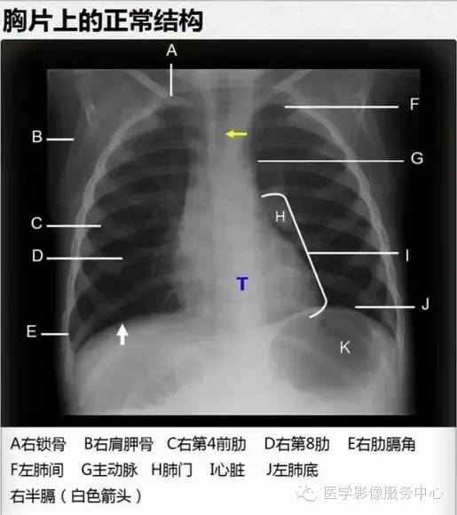 正位、侧位胸片的读片法，务必收藏！