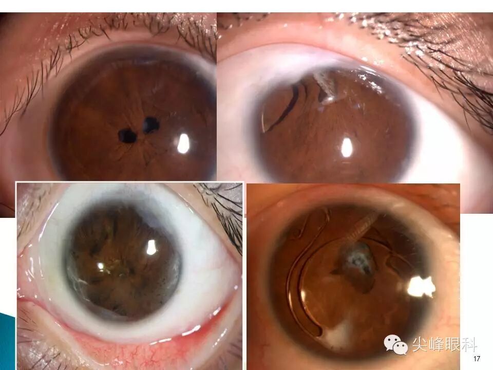 尖峰眼科之:白内障术后并发症 part1 李灿