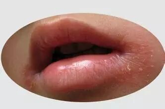 强哥每日皮肤科普 0810 口角炎 强哥每日科普 微文库