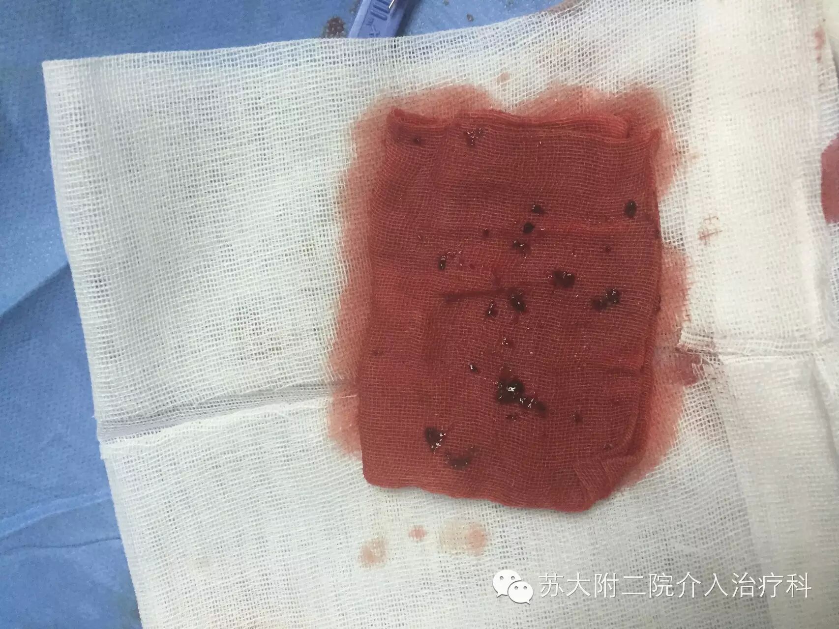 图示:纱布上暗红色的就是抽出的门静脉系统血栓.