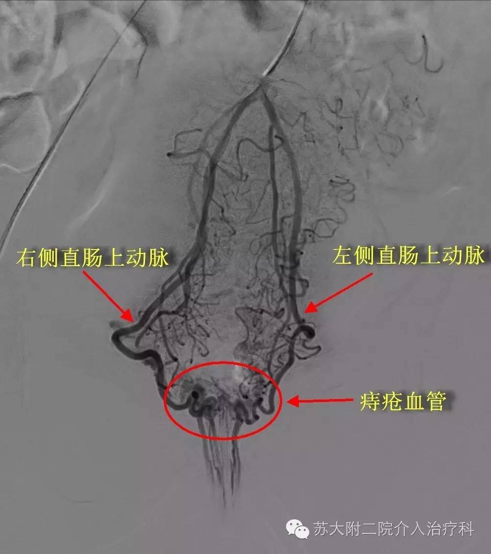 这是患者的栓塞前直肠周围动脉造影的图片,可见左右直肠动脉都明显变