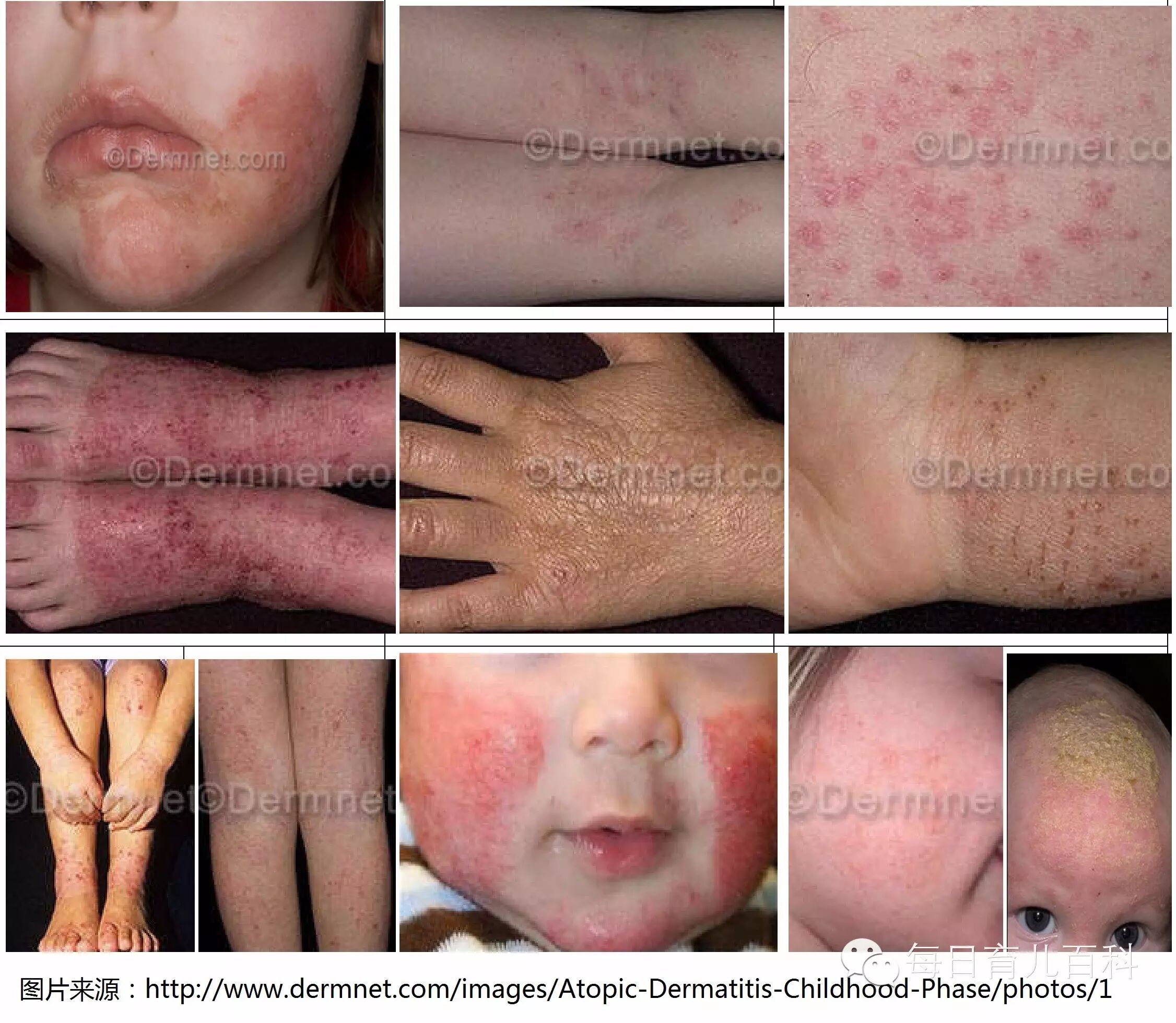 关于湿疹的那些事