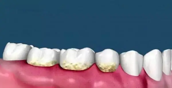 3.png 墨尔本洗牙洁牙 | 洗牙小常识 | 特惠四合一洗牙