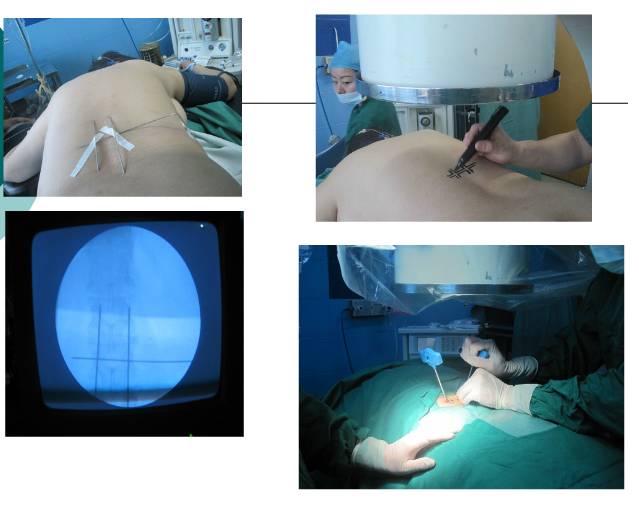 骨科用什么手术器械骨科基础 ｜ 椎体成形成套手术器械的使用方法_https://www.jmylbn.com_新闻资讯_第1张