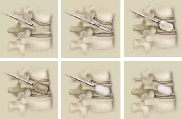 骨科用什么手术器械骨科基础 ｜ 椎体成形成套手术器械的使用方法_https://www.jmylbn.com_新闻资讯_第3张