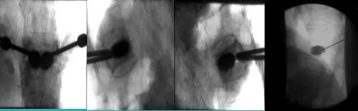 骨科用什么手术器械骨科基础 ｜ 椎体成形成套手术器械的使用方法_https://www.jmylbn.com_新闻资讯_第4张