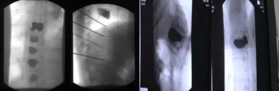 骨科用什么手术器械骨科基础 ｜ 椎体成形成套手术器械的使用方法_https://www.jmylbn.com_新闻资讯_第2张