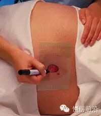 人工敷料怎么照顾伤口临床常见伤口敷料的优点和缺点_https://www.jmylbn.com_新闻资讯_第6张