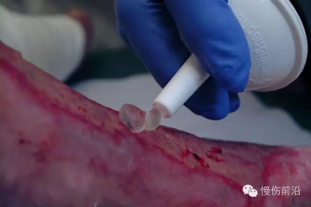 人工敷料怎么照顾伤口临床常见伤口敷料的优点和缺点_https://www.jmylbn.com_新闻资讯_第15张