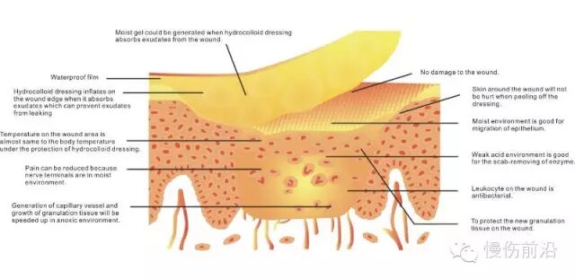 人工敷料怎么照顾伤口临床常见伤口敷料的优点和缺点_https://www.jmylbn.com_新闻资讯_第10张