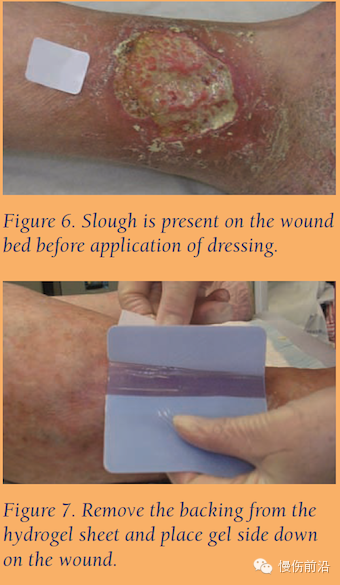 抗菌清创敷料怎么使用自溶性清创在下肢静脉溃疡的应用_https://www.jmylbn.com_新闻资讯_第7张