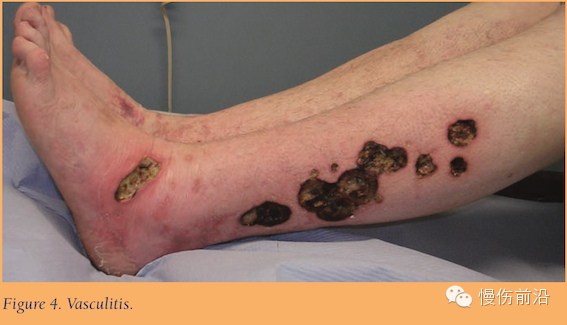 抗菌清创敷料怎么使用自溶性清创在下肢静脉溃疡的应用_https://www.jmylbn.com_新闻资讯_第5张