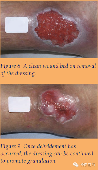 抗菌清创敷料怎么使用自溶性清创在下肢静脉溃疡的应用_https://www.jmylbn.com_新闻资讯_第8张