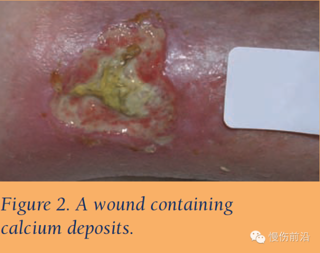 抗菌清创敷料怎么使用自溶性清创在下肢静脉溃疡的应用_https://www.jmylbn.com_新闻资讯_第3张