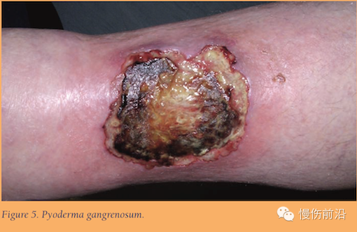 抗菌清创敷料怎么使用自溶性清创在下肢静脉溃疡的应用_https://www.jmylbn.com_新闻资讯_第6张