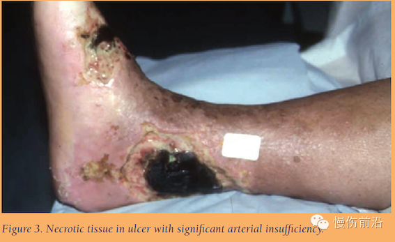 抗菌清创敷料怎么使用自溶性清创在下肢静脉溃疡的应用_https://www.jmylbn.com_新闻资讯_第4张