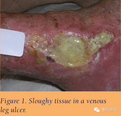 抗菌清创敷料怎么使用自溶性清创在下肢静脉溃疡的应用_https://www.jmylbn.com_新闻资讯_第2张
