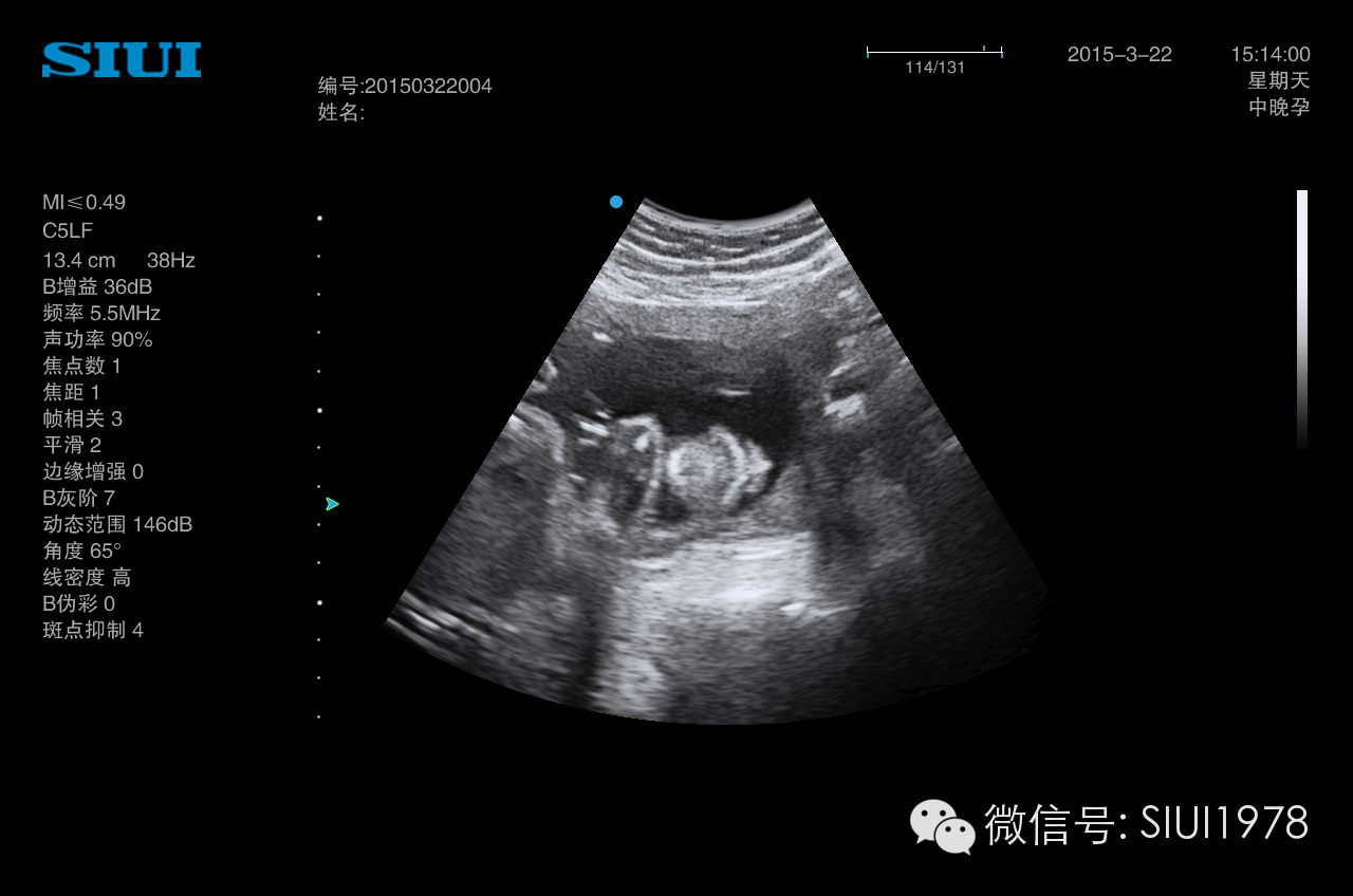 胎兒系統超聲檢查切面及臨床意義一