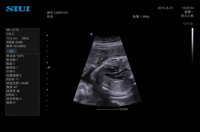 siui彩超怎么测量彩超诊断技巧汇编_https://www.jmylbn.com_新闻资讯_第2张