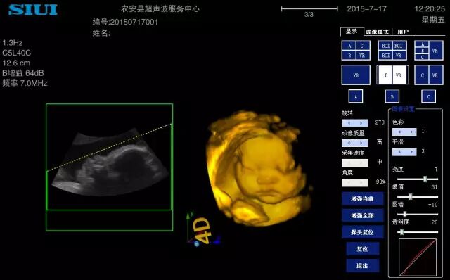 siui彩超怎么测量彩超诊断技巧汇编_https://www.jmylbn.com_新闻资讯_第3张