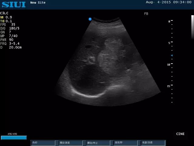 siui彩超怎么测量彩超诊断技巧汇编_https://www.jmylbn.com_新闻资讯_第1张